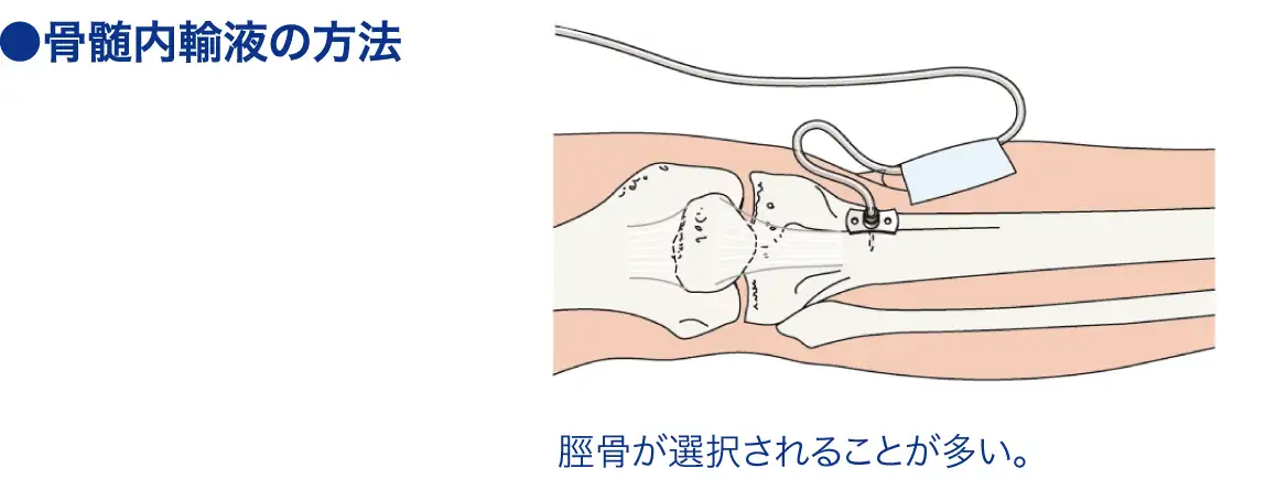 アイオー（IO）[骨髄内輸液]│看護師ライフをもっとステキに ナースプラス