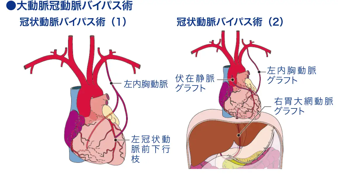 冠動脈バイパス術│看護師ライフをもっとステキに ナースプラス