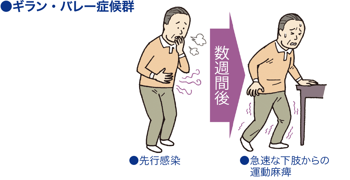 ギラン・バレー症候群[急性炎症性脱髄性多発根神経炎]│看護師ライフを