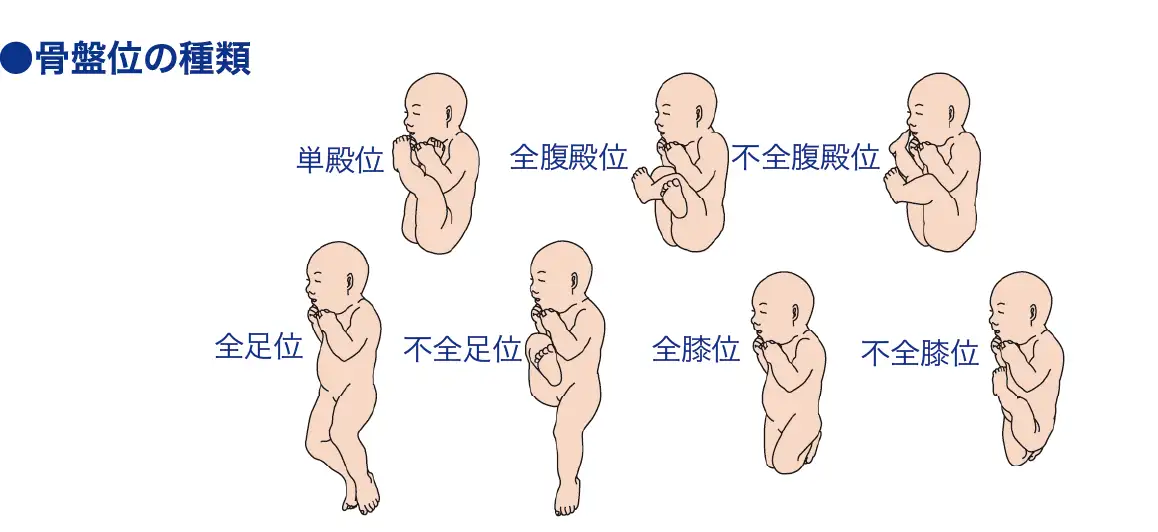 骨盤位[ベッケン位]│看護師ライフをもっとステキに ナースプラス