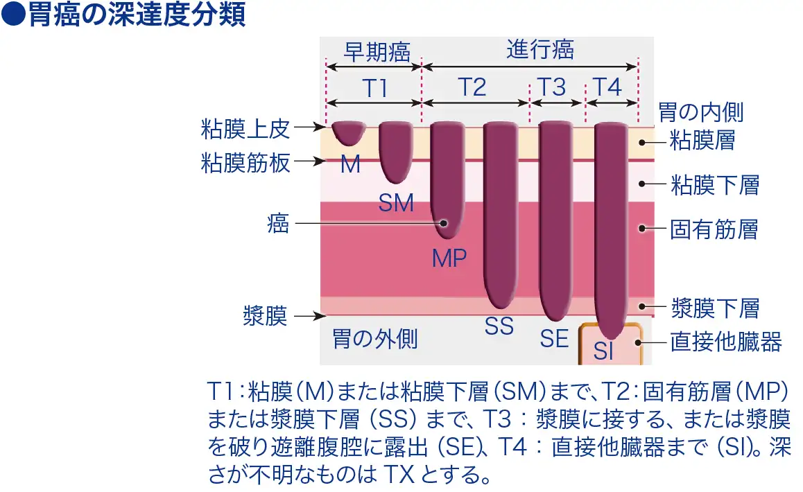 固有筋層までの癌│看護師ライフをもっとステキに ナースプラス