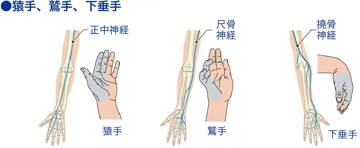 猿手（さるて）│看護師ライフをもっとステキに ナースプラス