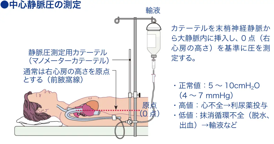 シーブイピー（CVP）[中心静脈圧]│看護師ライフをもっとステキに