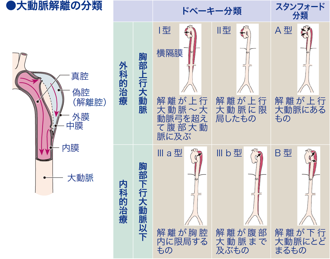 ドベーキー分類│看護師ライフをもっとステキに ナースプラス