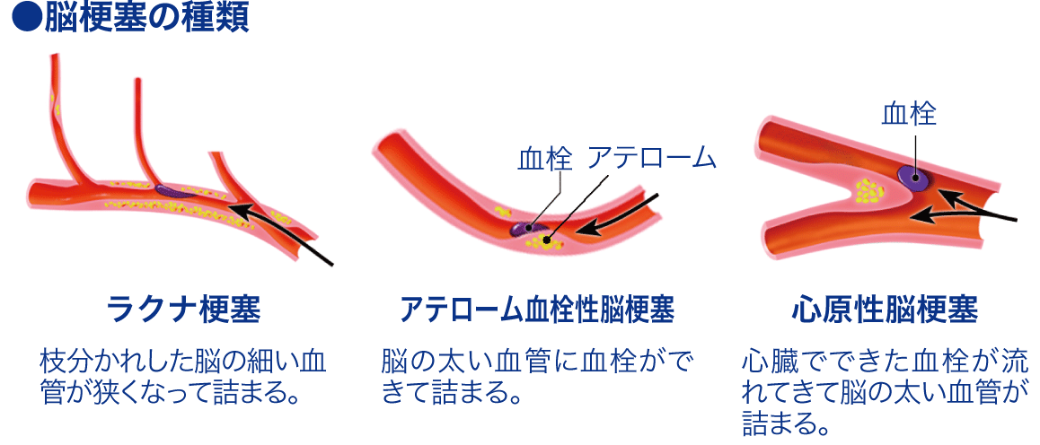 脳梗塞│看護師ライフをもっとステキに ナースプラス