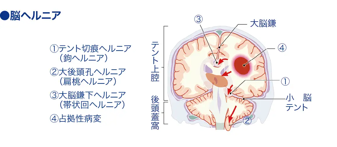 脳ヘルニア[脳嵌頓]│看護師ライフをもっとステキに ナースプラス