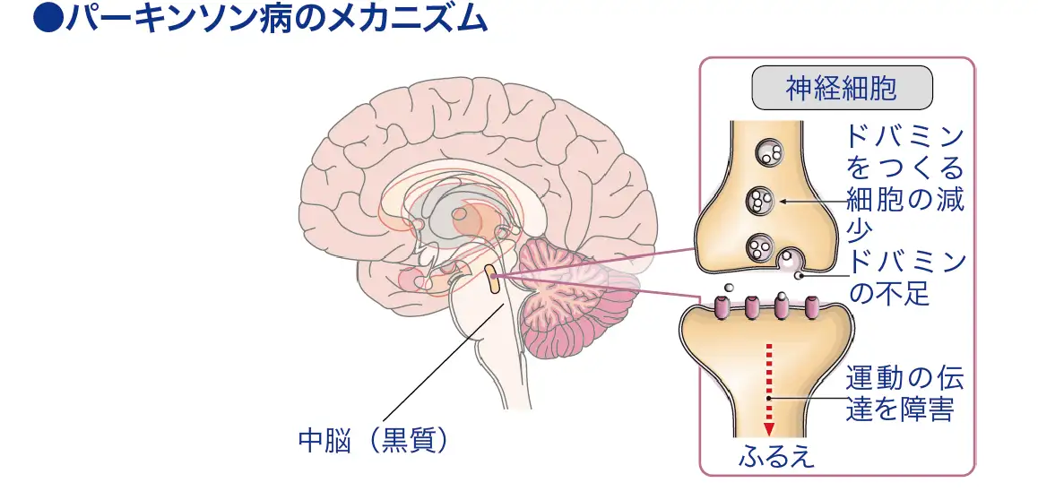 パーキンソン病 看護師ライフをもっとステキに ナースプラス