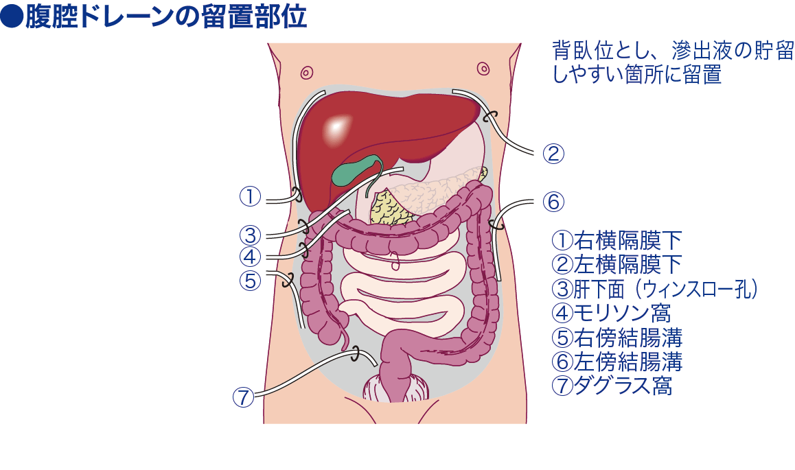 腹腔ドレナージ│看護師ライフをもっとステキに ナースプラス