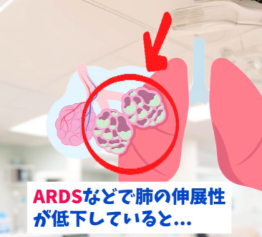 人工呼吸器のPCとVCの違いは？1分のリール動画で要点解説！